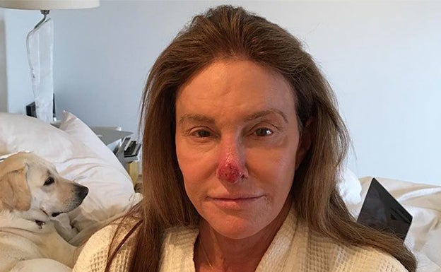 Caitlyn Jenner con una herida en la nariz antes de ser intervenida.