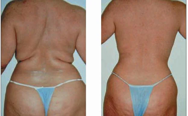 El antes y el después de la aplicación de un tratamiento en Ana GB Estética Científica.